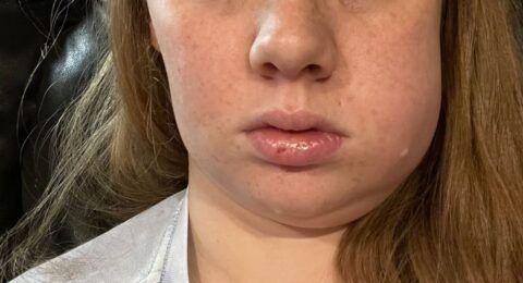 Swollen-face-480x260.jpg