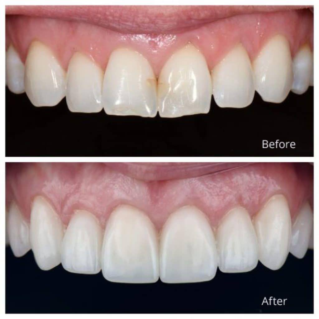 Veneer3.jpeg