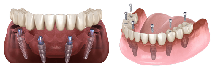 all-on-4 dentures.png