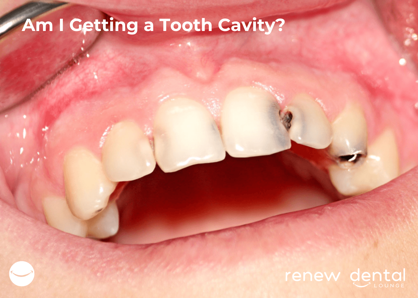 article-cavity-inline-1.png