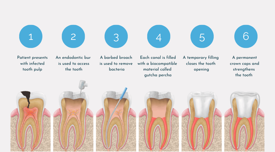 article-root-canal-inline-1.png