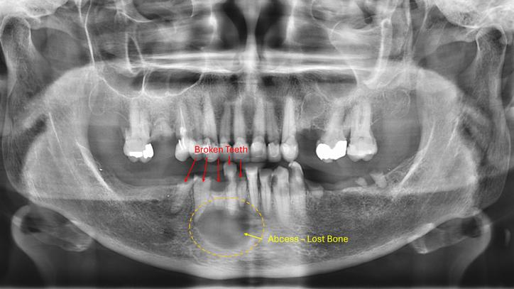 bone loss.jpg