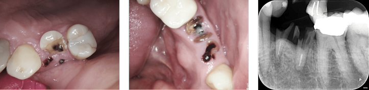 broken teeth.png