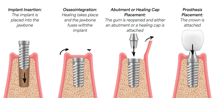 dental implant steps.png