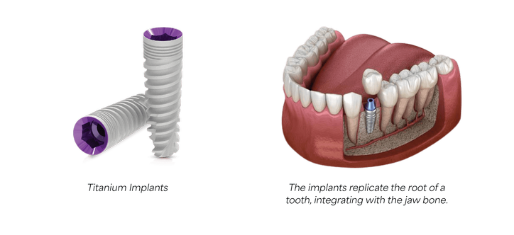 dental implants.png
