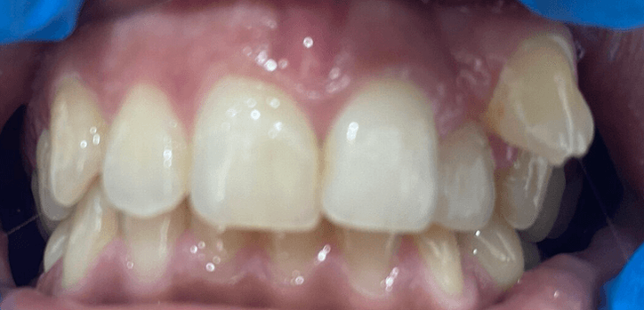 malpositioned tooth.png