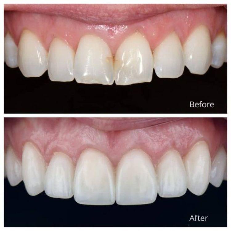 Veneer3.jpeg
