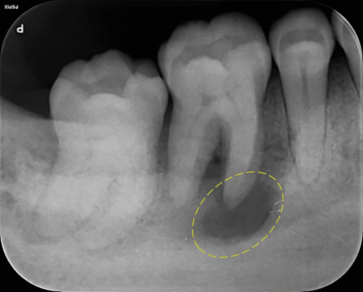 root canal bone loss.png