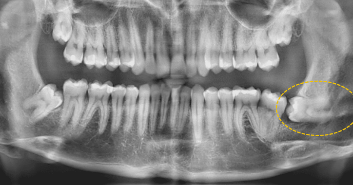 wisdom tooth surgical extraction.png
