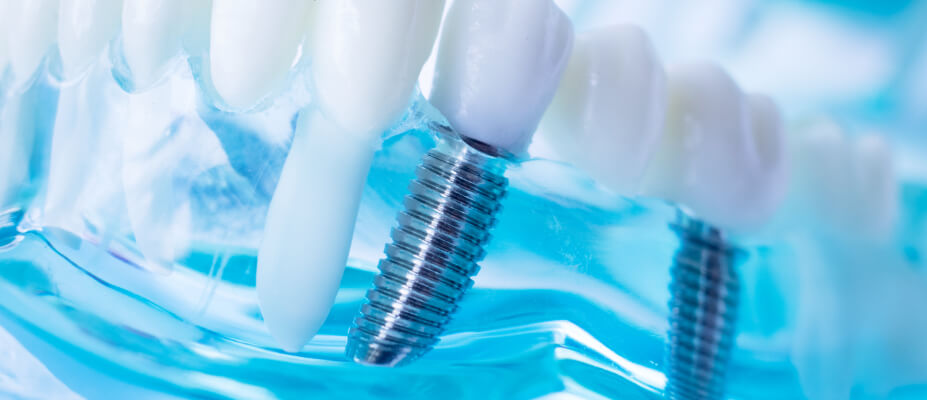 Want to know about Dental Implants?