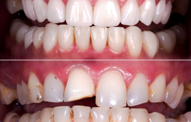 dental crowns