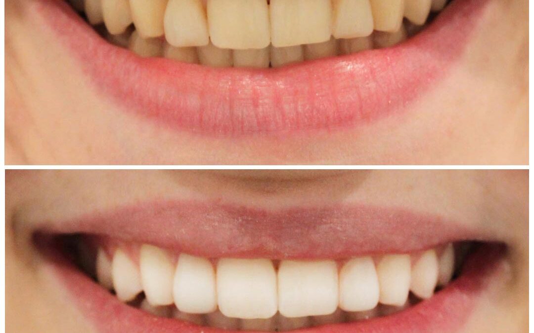 Light up your Smile with Tooth Whitening