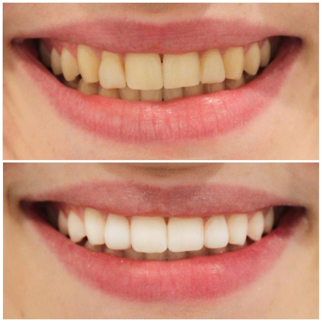 Before & after Tooth Whitening