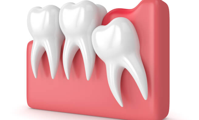 wisdom tooth extraction