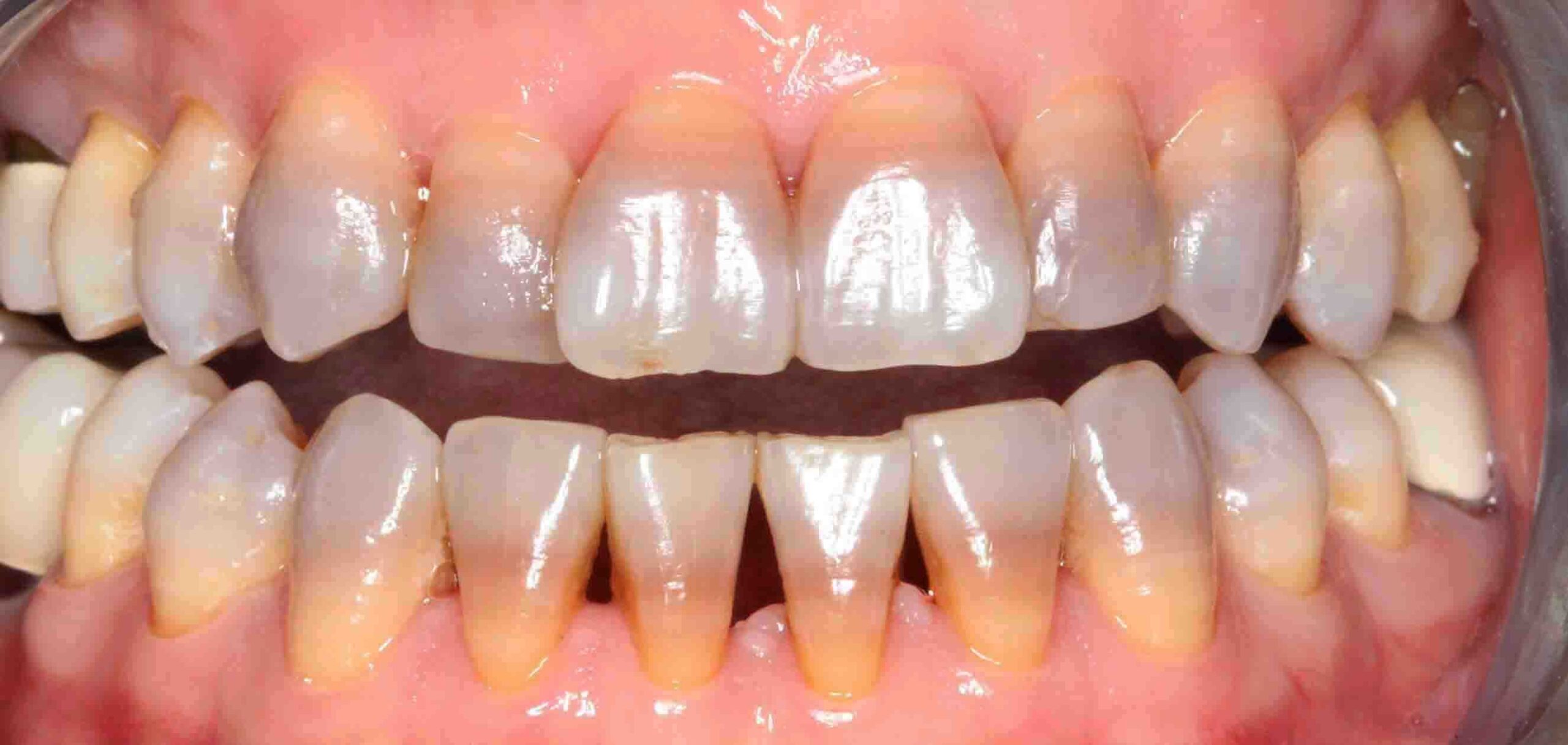 Discoloured Teeth