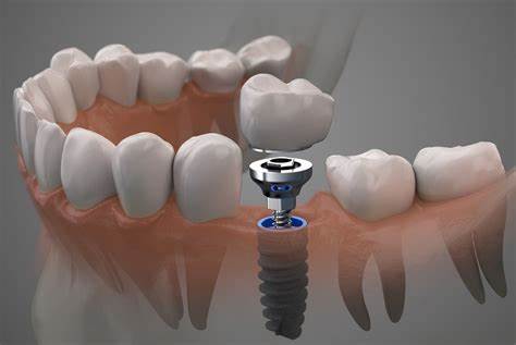 Lets Talk about a Dental Implant