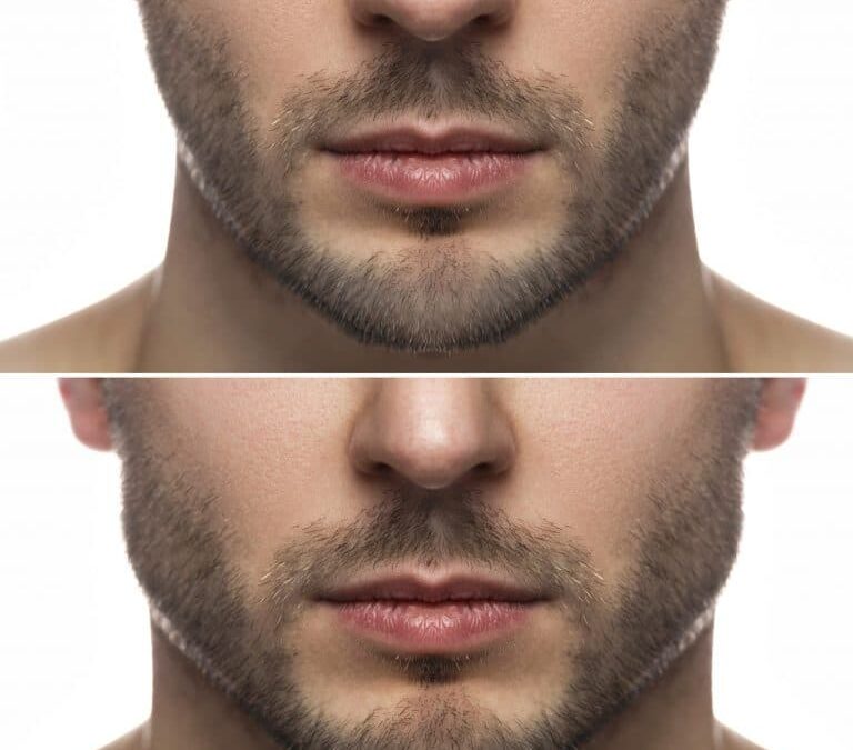 Jaw-Slimming or TMD?