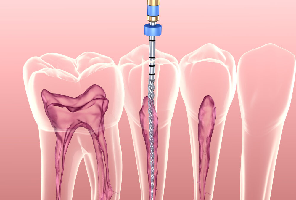 Lets Talk about Root Canal Treatment