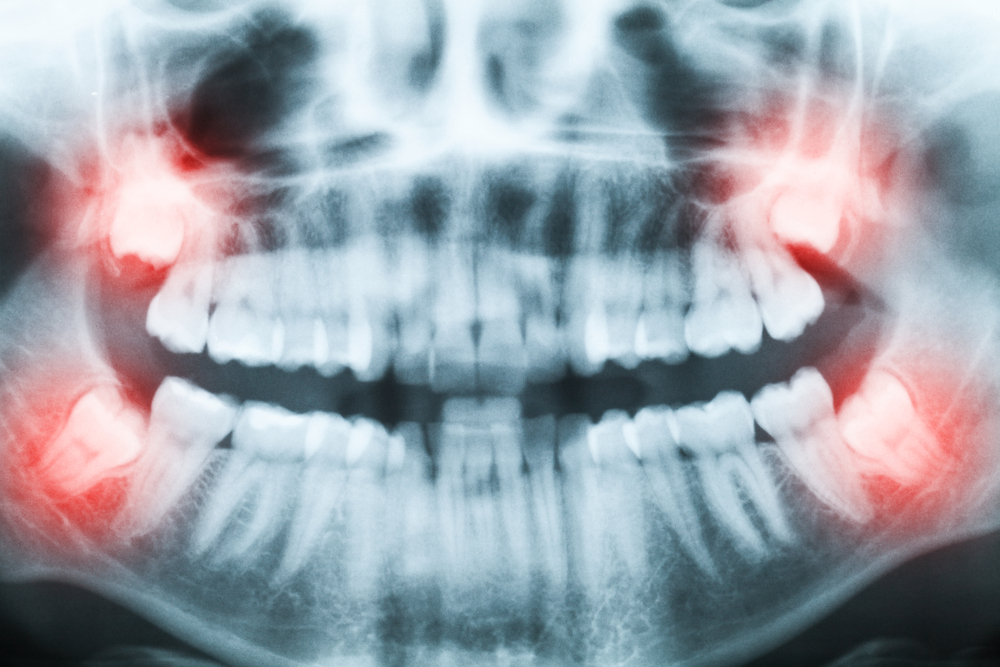 Lets talk about Wisdom Tooth Extraction