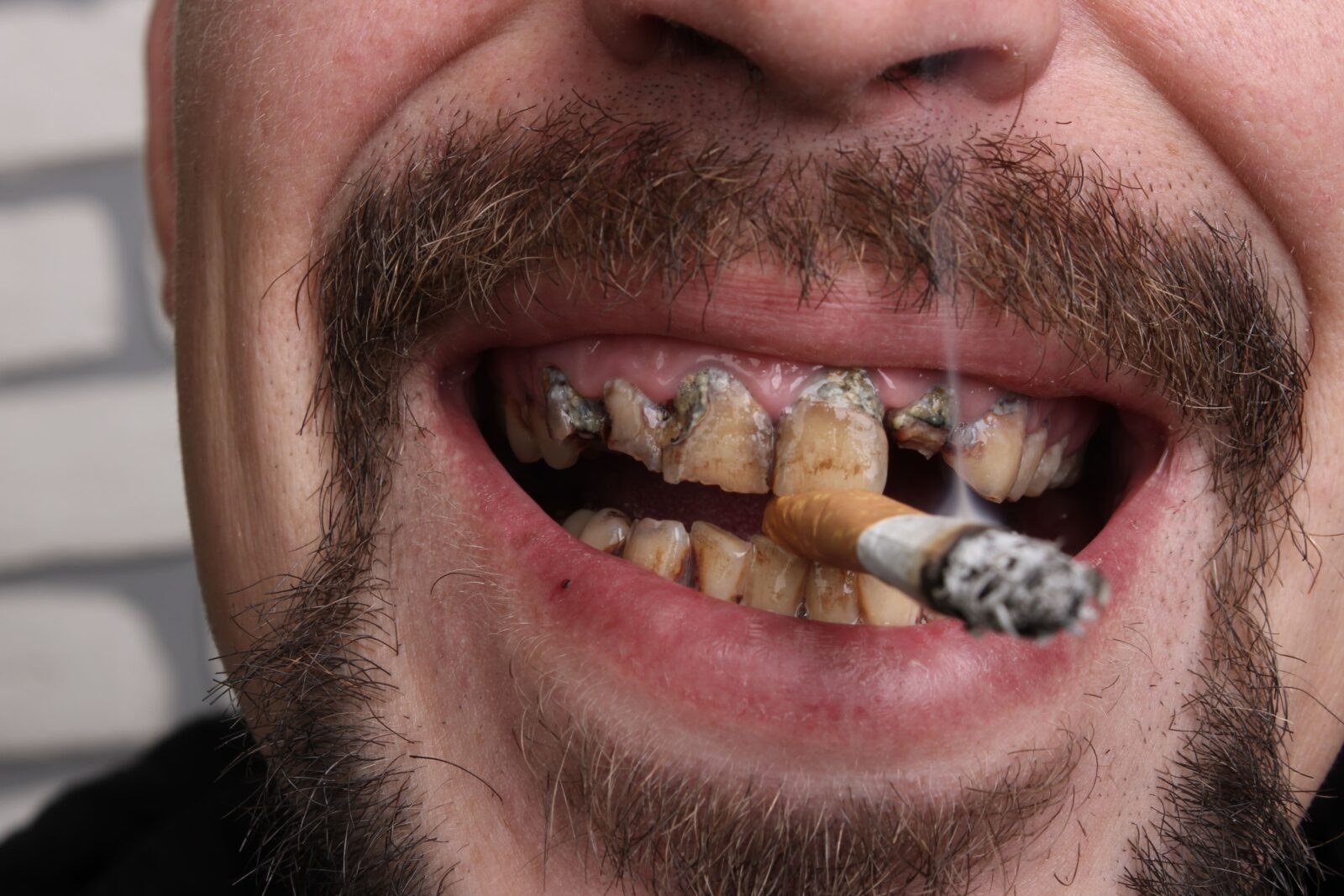 smoking and bad teeth