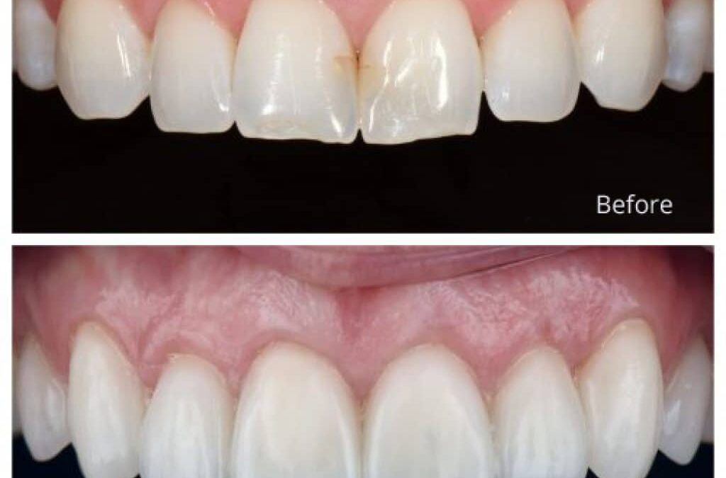 Dental Veneers: A Smile Transformation