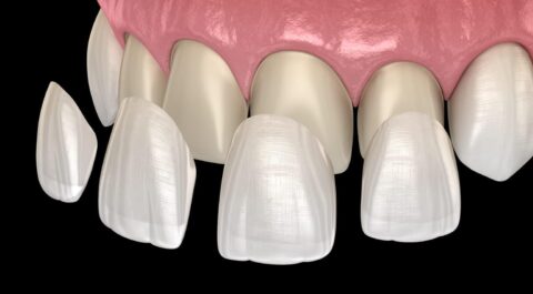 dental veneers