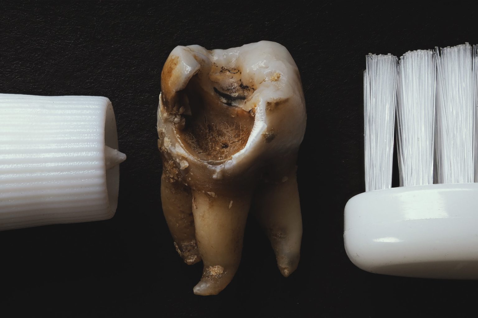 tooth decay 1536x1024