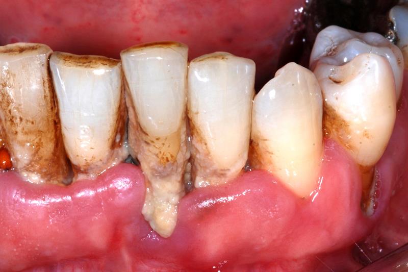 Periodontal disease